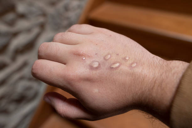 Monkeypox Mulai Muncul, Dinkes Ajak Masyarakat Kenali Gejala dan Jaga Kesahatan