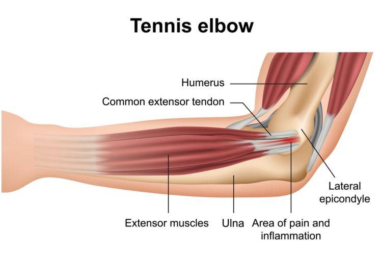 RSUD Genteng Tingkatkan Pelayanan dengan Edukasi Pencegahan Tennis Elbow